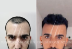 Hair Transplant Turkey Before and After: Dr. Serkan Aygin Clinic Achieves Great Results